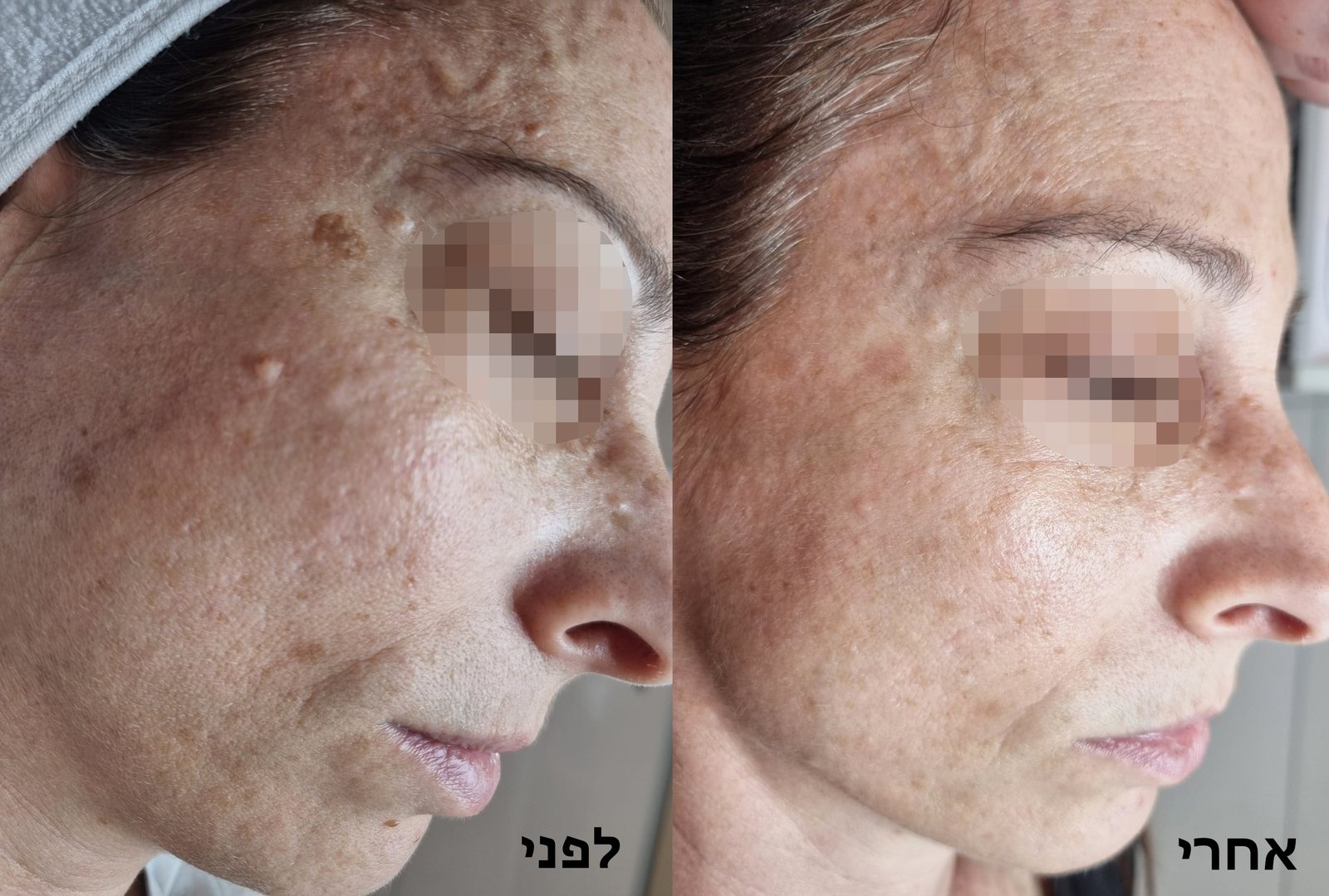 לפני ואחרי: טיפול בפיגמנטציה והסרת תגי עור - דוינה דניאל קוסמטיקאית ראש העין