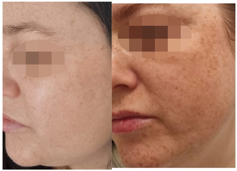 לפני ואחרי: טיפול בפיגמנטציה בפנים - דוינה דניאל