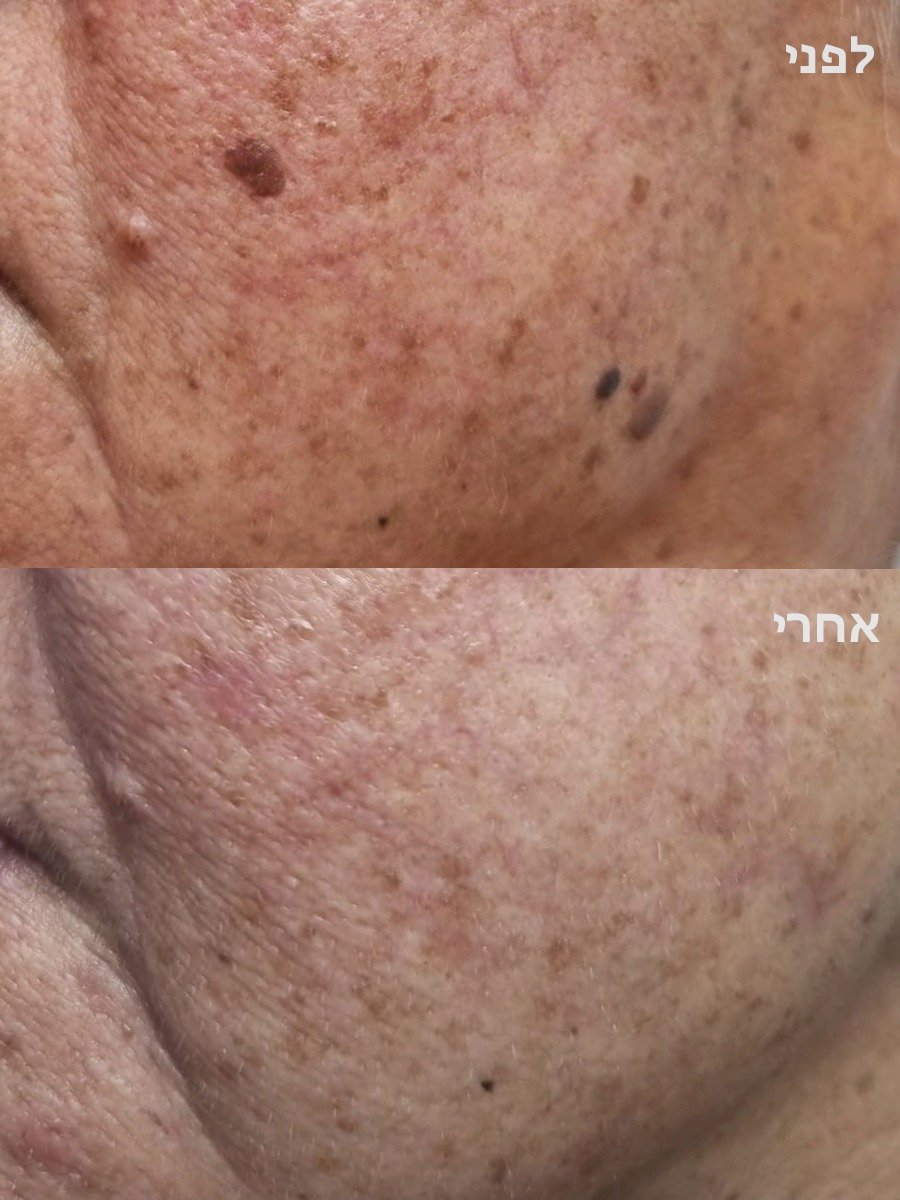 לפני ואחרי: הסרת לנטיגו ותגי עור בפנים