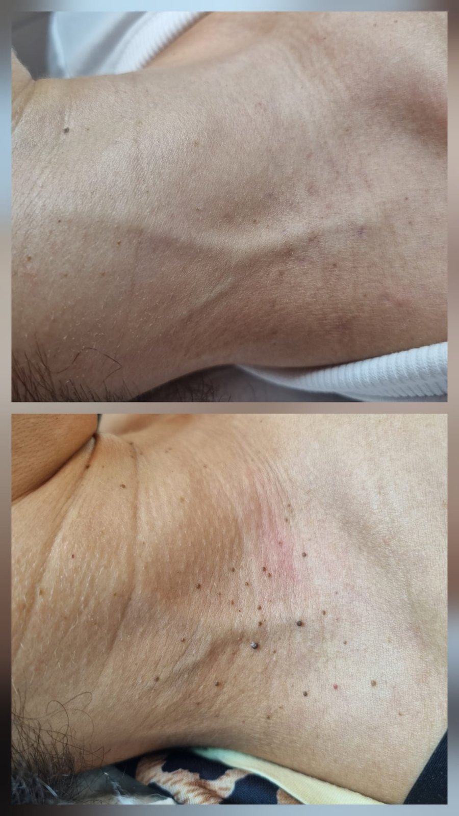 לפני ואחרי: הסרת תגי עור (Skin Tags) בקליניקה של דוינה דניאל