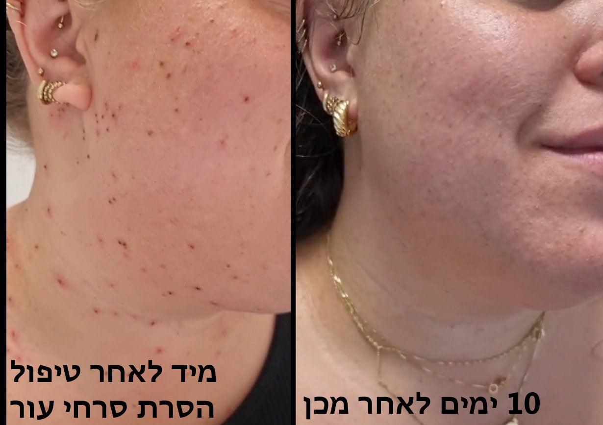 לפני ואחרי: הסרת תגי עור