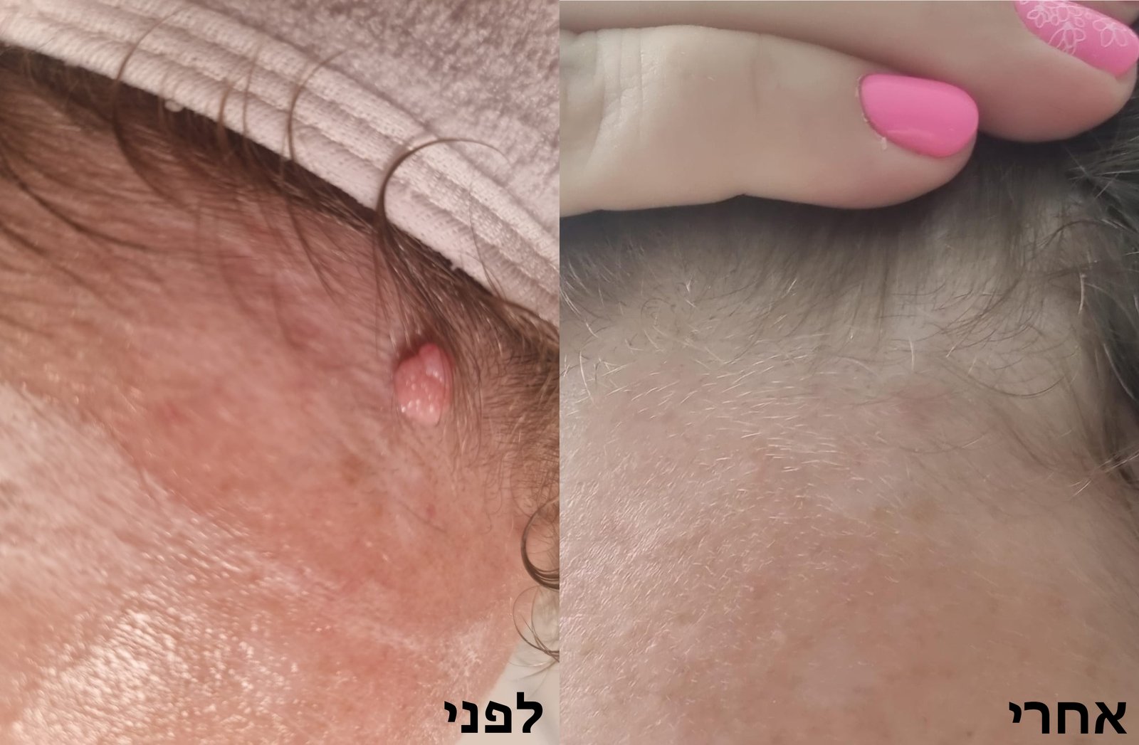 לפני ואחרי: הסרת נקודת חן שפירה