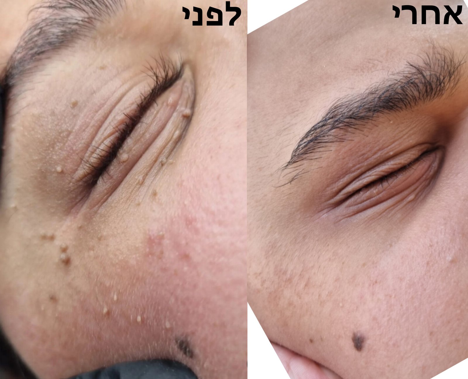 לפני ואחרי: הסרת תגי עור באזור הפנים