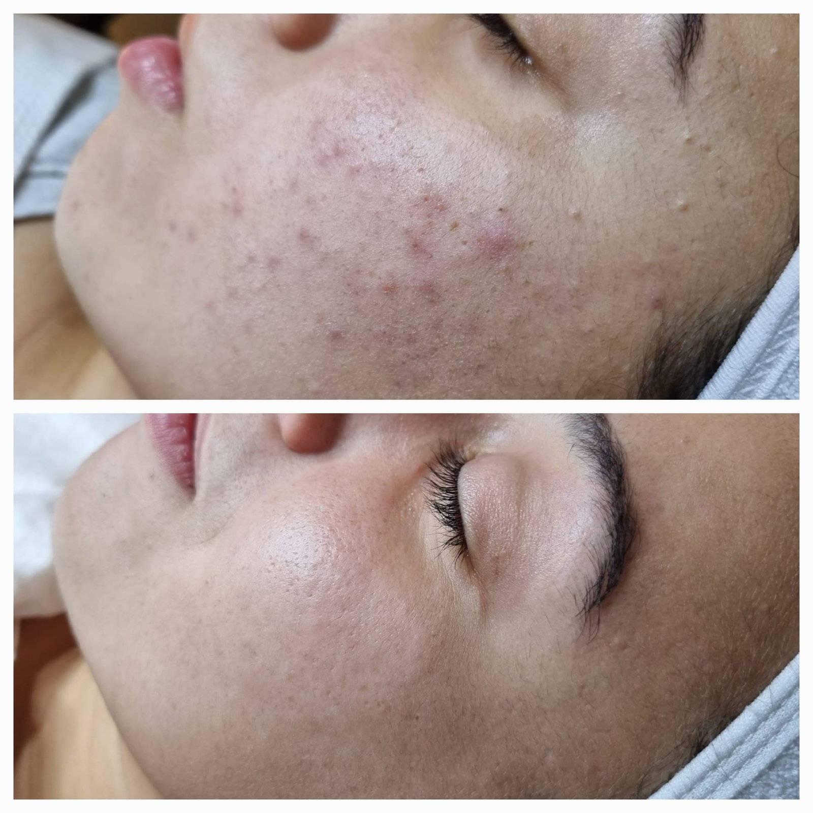 לפני ואחרי: טיפול באקנה קומדונלית (חצ'קונים ונקודות שחורות)