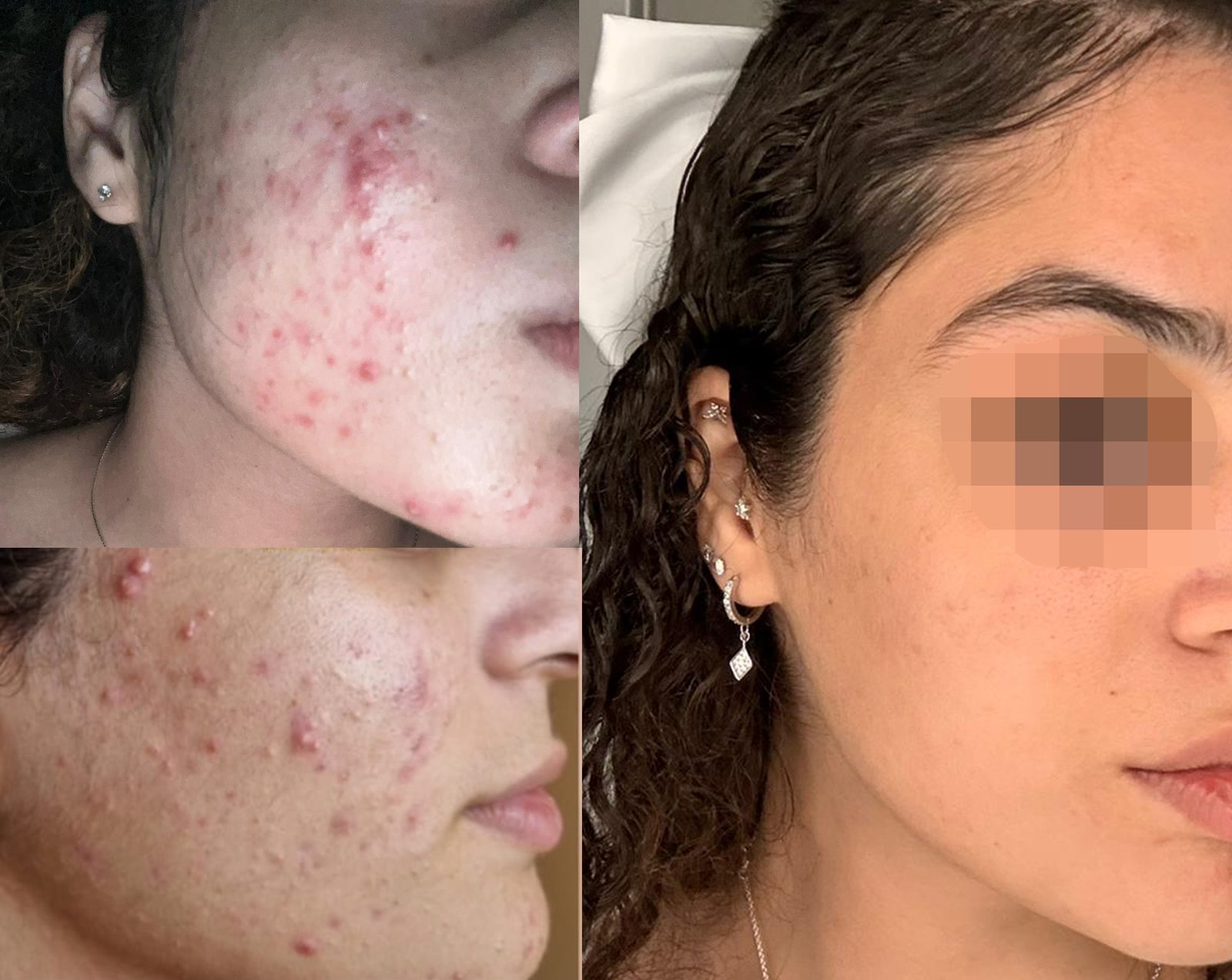 לפני ואחרי: טיפול באקנה דלקתי